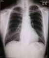 lung080811-01.jpg (45526 バイト)